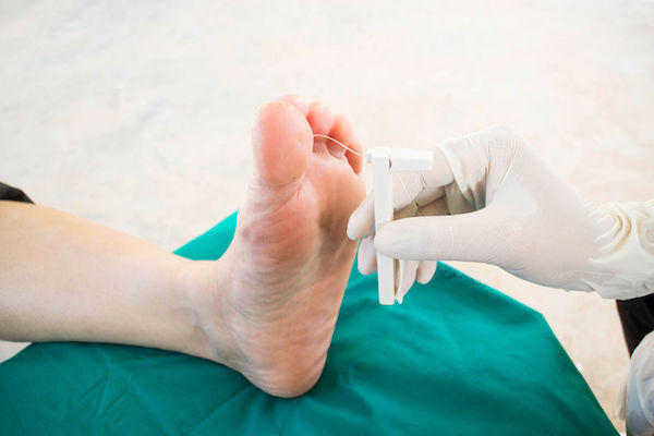 A doctor testing for diabetic neuropathy