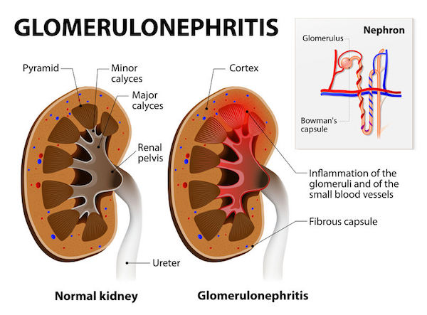 A medical diagram of glomerulonephritis