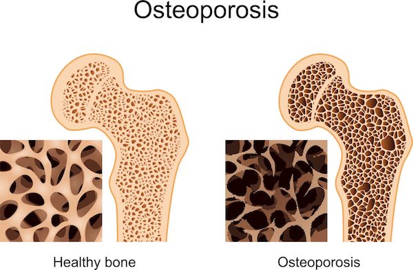 A medial diagram showing osteoporosis