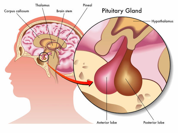 A medical diagram showing a pituitary neoplasm