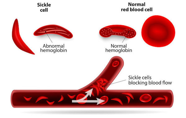 A medical illustration of sickle cell anaemia