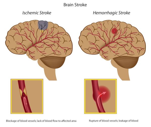 A diagram showing two different types of strokes