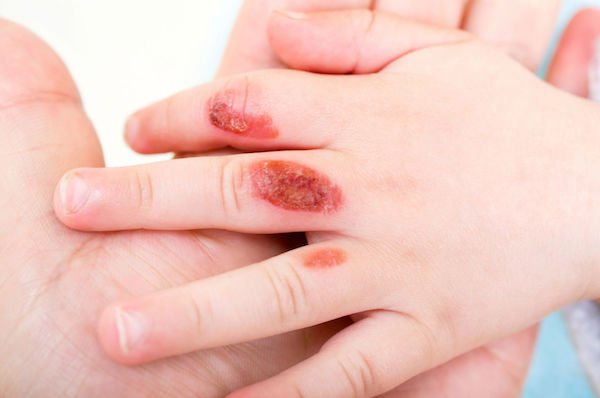 A child's hand showing burns on the fingers