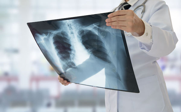 A doctor holding an x-ray of a pair of lungs