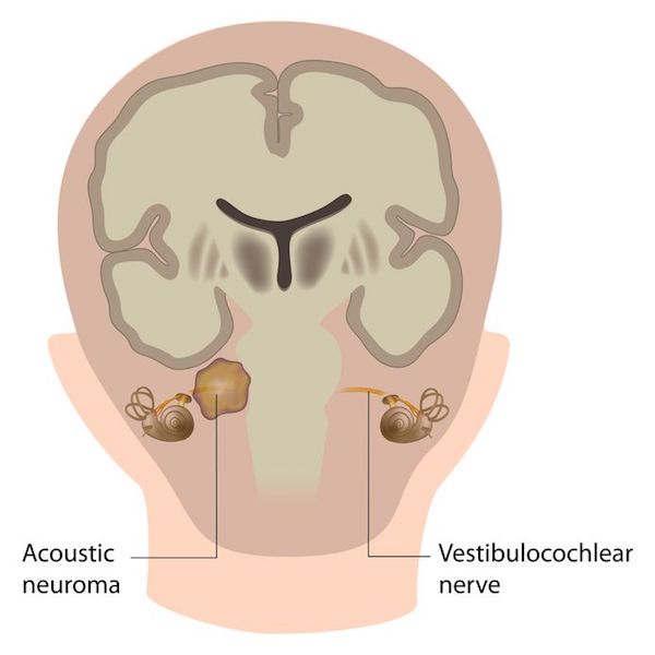 A medical diagram showing Acoustic neuroma (vestibular Schwannoma)