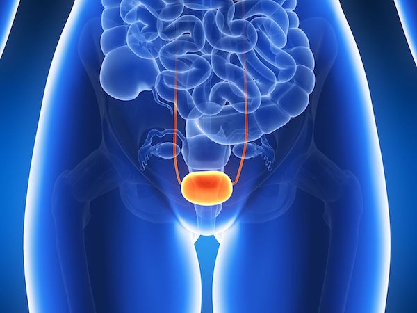 A medical diagram showing bladder cancer