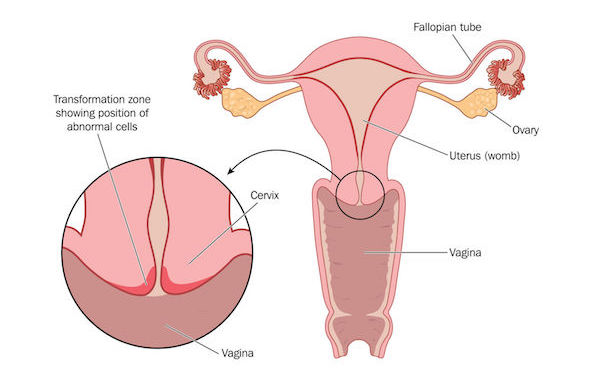 A medical diagram detailing cervical cancer