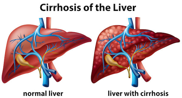 A medical diagram showing cirrhosis of the liver