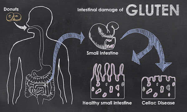 An illustrated look at coeliac disease