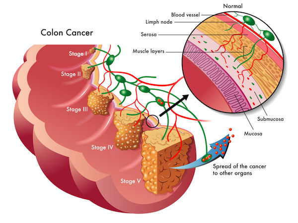 A medical diagram of colorectal cancer