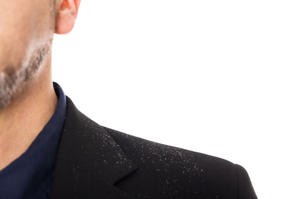 A man with dandruff on his shoulder