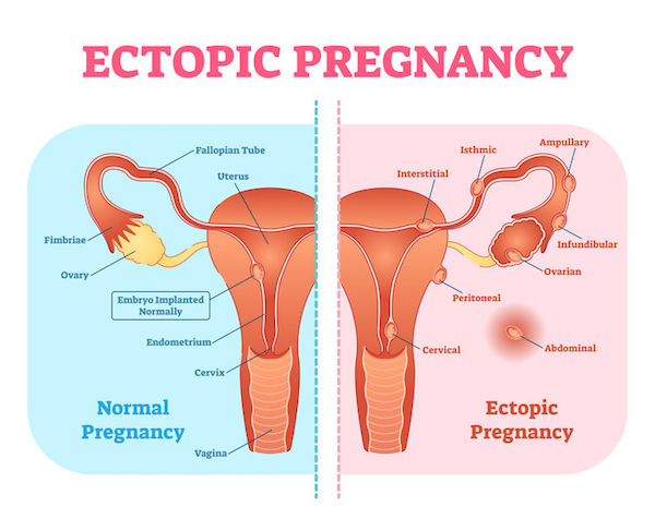 A medical diagram showing an ectopic pregnancy