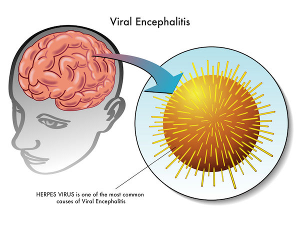 A medical diagram on encephalitis