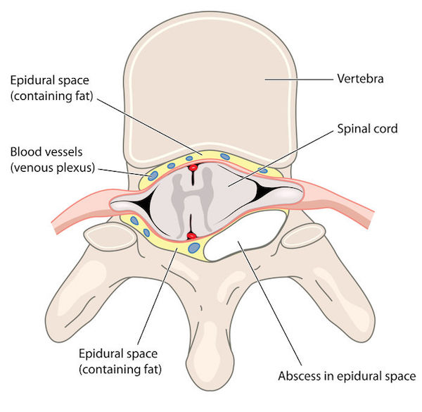 A medical diagram showing an epidural abscess