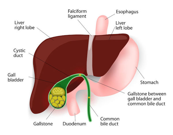 A medical diagram showing gallstones