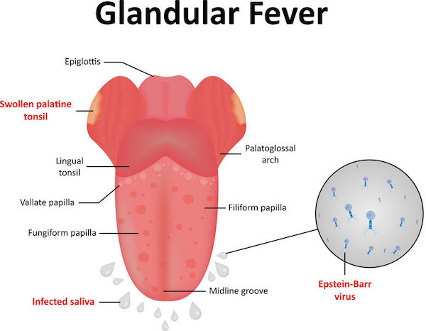 A medical diagram of glandular fever