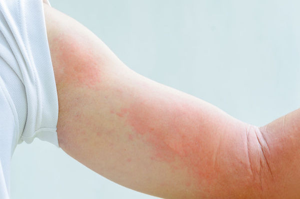 A woman with hives on her arm