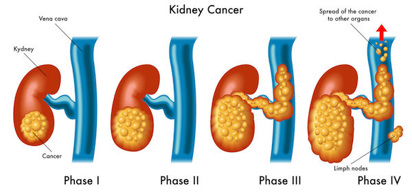 A medical diagram showing the stages of kidney cancer