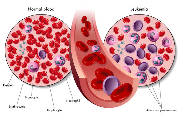 A medical diagram of leukaemia