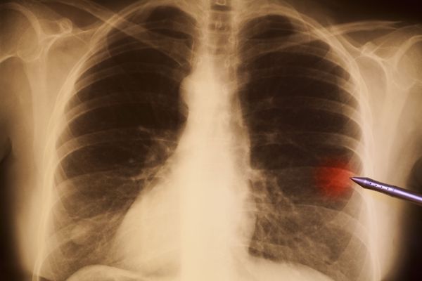An x-ray showing a spot on a lung