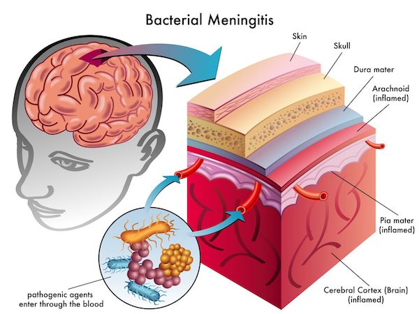 A medical diagram of meningitis