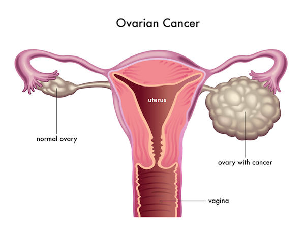 A medical diagram showing ovarian cancer