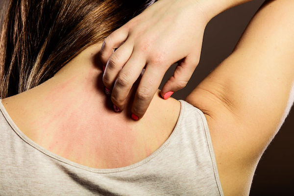 A woman scratching a rash on her back