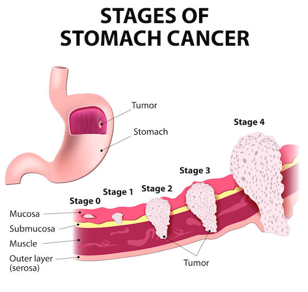 A diagram showing the stages of stomach cancer