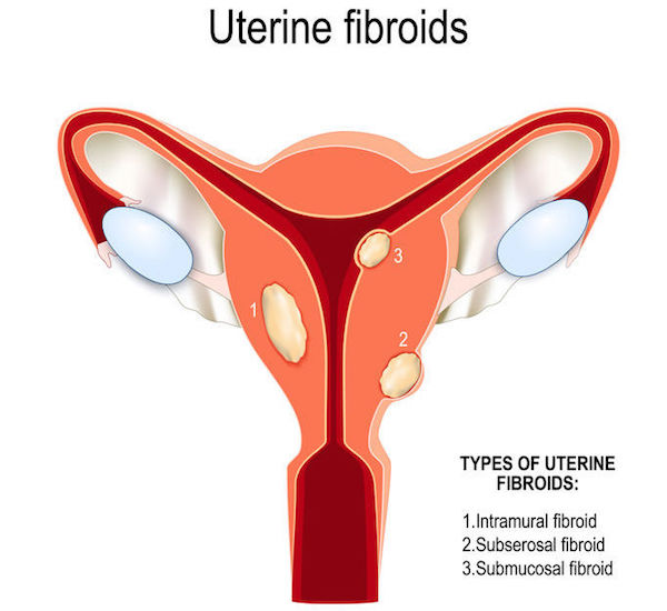 A medical illustration of uterine fibroids