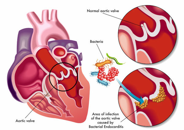 A medical diagram showing a healthy heart and one with infective endocarditis