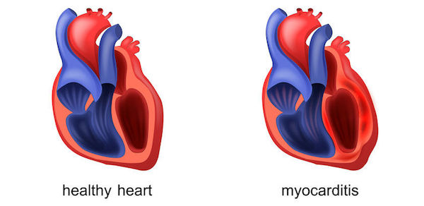 A medical illustration of myocarditis