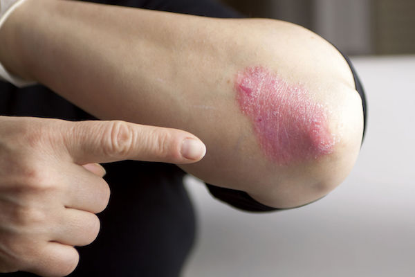 A woman with psoriasis on her arm